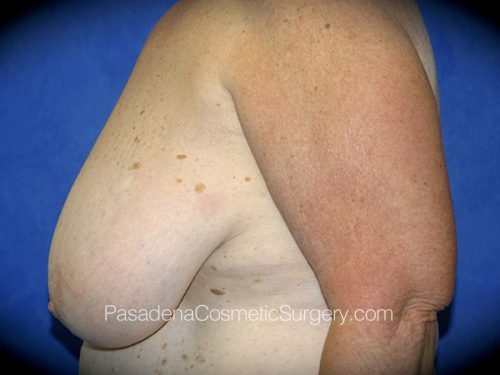 Breast Reduction Patient 05 Before - 2