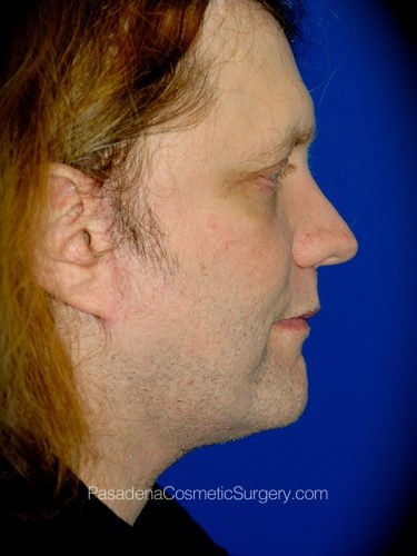 Neck Lift Patient 02 After