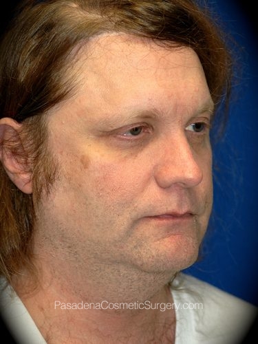 Neck Lift Patient 02 Before - 2