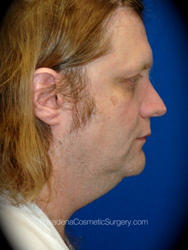 Neck Lift Patient 02 Before