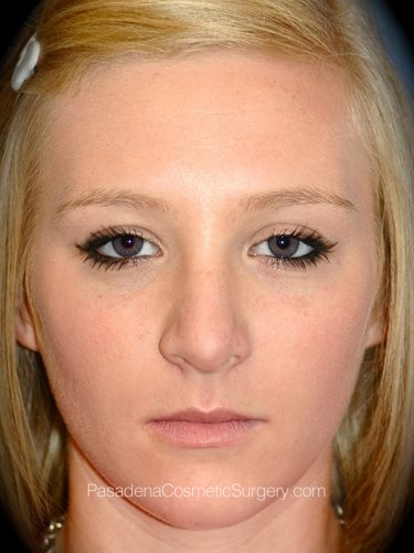 Rhinoplasty Patient 08 After