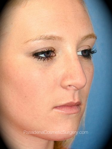 Rhinoplasty Patient 08 After - 2