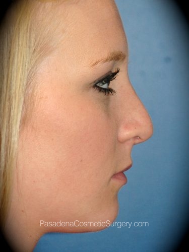 Rhinoplasty Patient 08 After - 3