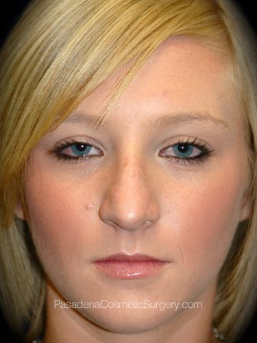 Rhinoplasty Patient 08 Before