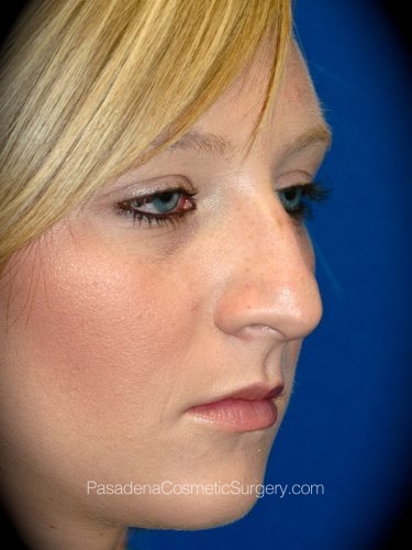 Rhinoplasty Patient 08 Before - 2