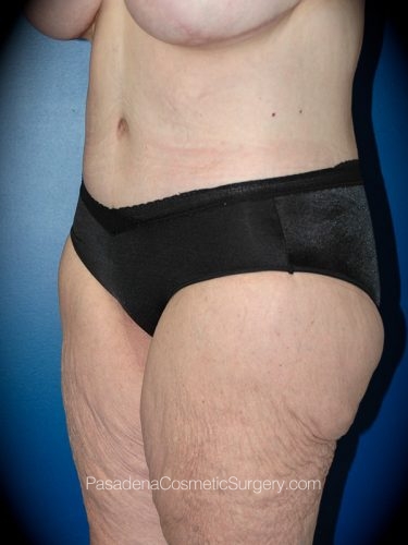 Body Lift Patient 04 After - 2