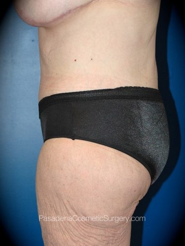 Body Lift Patient 04 After - 3