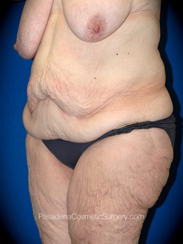 Body Lift Patient 04 Before - 2