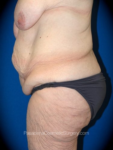 Body Lift Patient 04 Before - 3