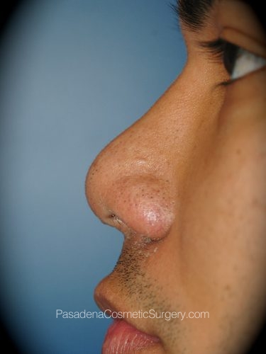 Rhinoplasty Patient 09 After - 2