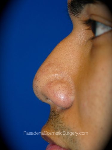 Rhinoplasty Patient 09 Before - 2