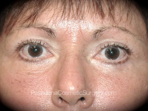 Eyelid Surgery Patient 22 After