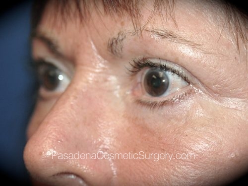 Eyelid Surgery Patient 22 After - 2
