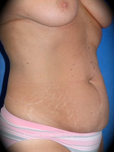 Tummy Tuck Patient 12 Before