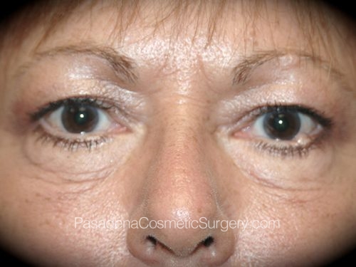Eyelid Surgery Patient 22 Before