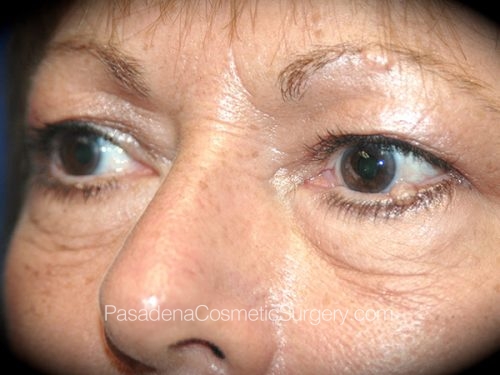 Eyelid Surgery Patient 22 Before - 2
