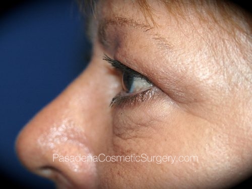 Eyelid Surgery Patient 22 Before - 3