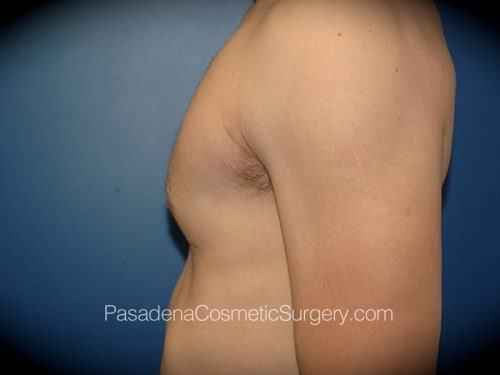 Gynecomastia Patient 04 After - 2