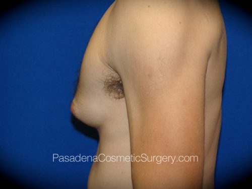 Gynecomastia Patient 04 Before - 2