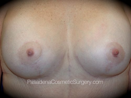 Breast Augmentation with Mastopexy Patient 07 After