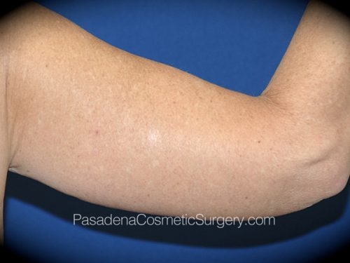 Arm Lift Patient 11 After - 2