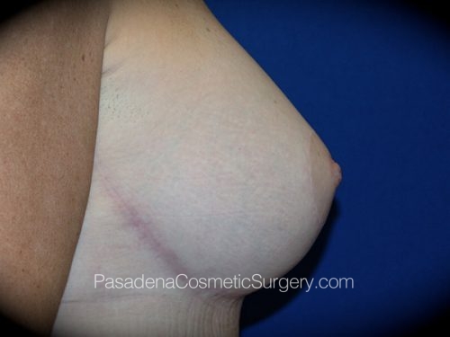 Breast Augmentation with Mastopexy Patient 07 After - 3