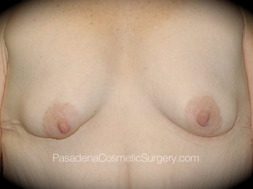 Breast Augmentation with Mastopexy Patient 07 Before
