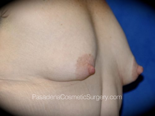 Breast Augmentation with Mastopexy Patient 07 Before - 2