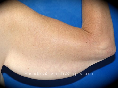 Arm Lift Patient 11 Before - 2