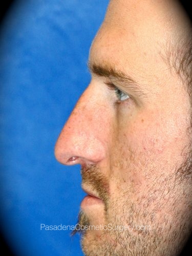 Rhinoplasty Patient 10 Before - 2