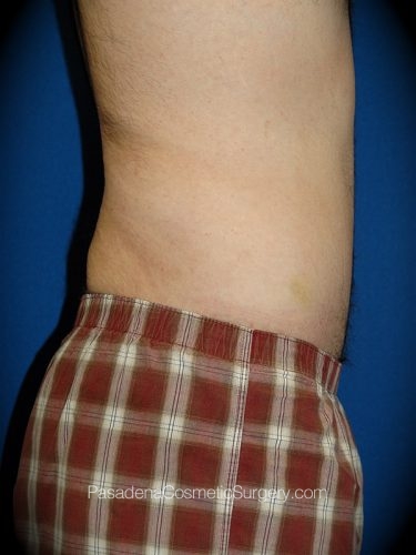 Tummy Tuck Patient 13 After - 2