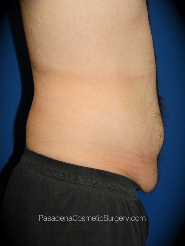 Tummy Tuck Patient 13 Before - 2