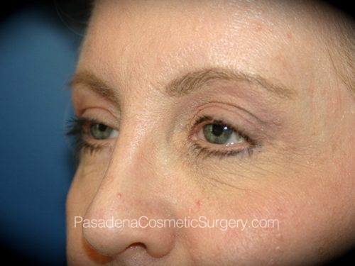 Eyelid Surgery Patient 23 After