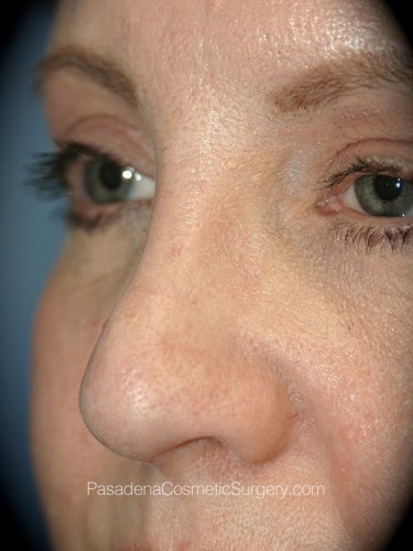 Rhinoplasty Patient 11 After - 2