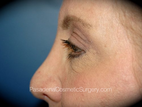 Eyelid Surgery Patient 23 After - 2