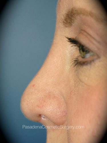 Rhinoplasty Patient 11 After - 3