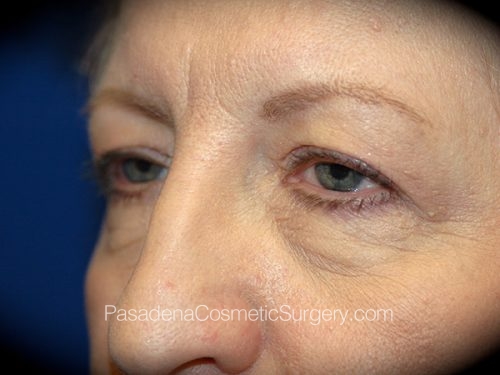 Eyelid Surgery Patient 23 Before