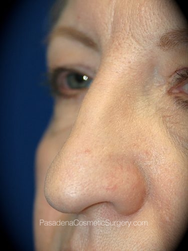 Rhinoplasty Patient 11 Before - 2