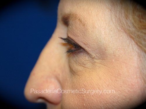 Eyelid Surgery Patient 23 Before - 2