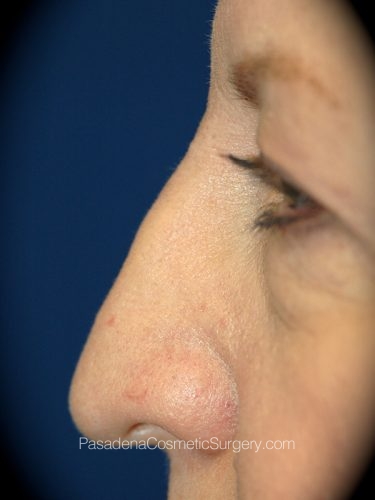 Rhinoplasty Patient 11 Before - 3