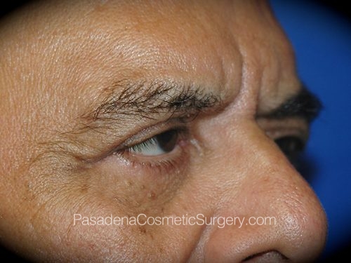 Eyelid Surgery Patient 24 After - 2