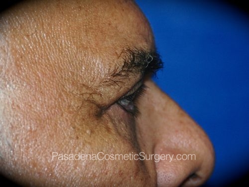 Eyelid Surgery Patient 24 After - 3