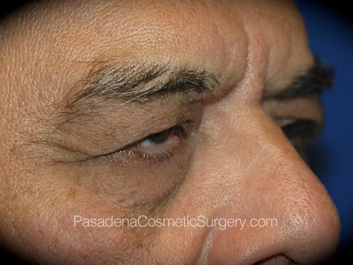 Eyelid Surgery Patient 24 Before - 2