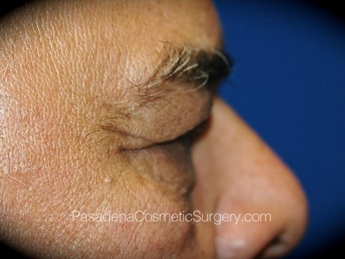 Eyelid Surgery Patient 24 Before - 3