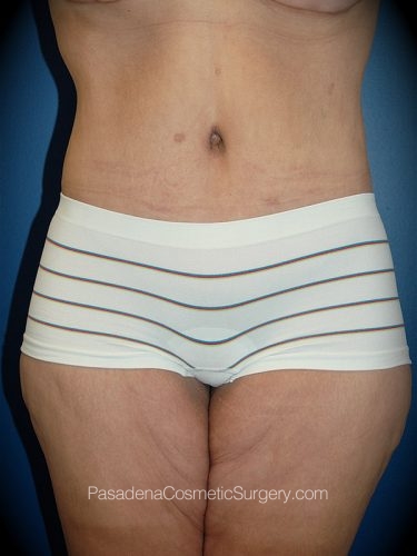 Tummy Tuck Patient 14 After