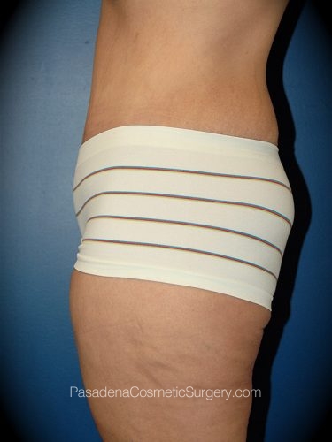 Tummy Tuck Patient 14 After - 2