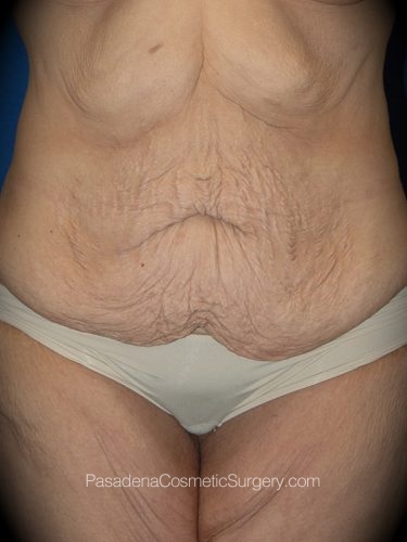 Tummy Tuck Patient 14 Before