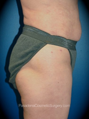 Liposuction Patient 03 After - 2