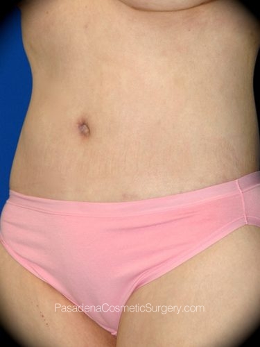 Body Lift Patient 05 After - 2