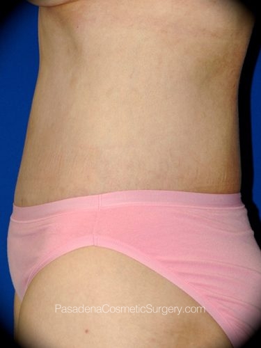 Body Lift Patient 05 After - 3